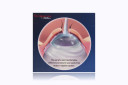 MorTan Morgan Medi-Flow Lens Ocular Irrigation Lens